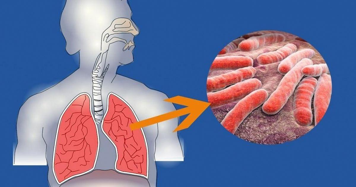 Меры профилактики туберкулеза