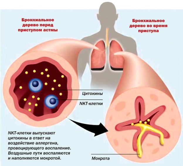  Бронхиальная астма 